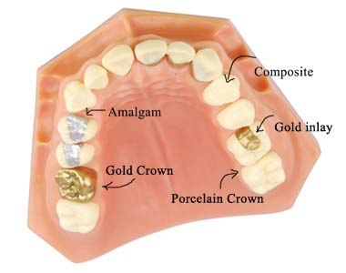 Model of different fillings