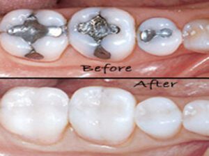before and after tooth filling